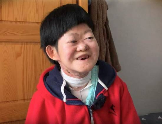 生命的奇迹！曾被断言活不过2岁的“蝴蝶宝贝”即将迎来25岁生日